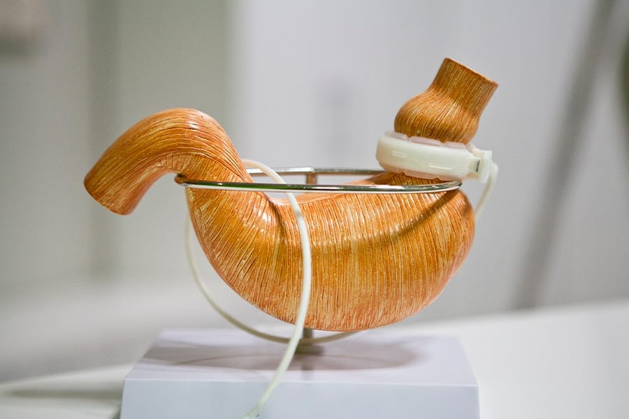 anneau gastrique chirurgie pour perte de poids docteur yann assaf chirurgien bariatrique paris