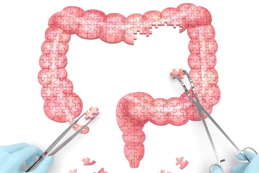 colectomie definition operation docteur yann assaf chirurgie paroi abdominale paris