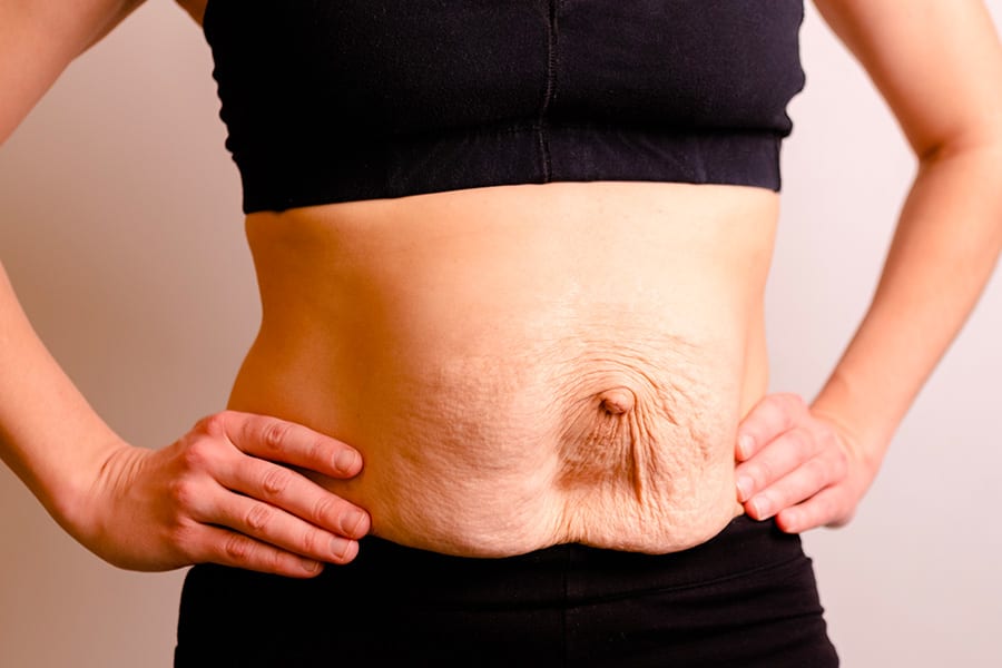 operation diastasis abdominale docteur yann assaf chirurgie parietale paris