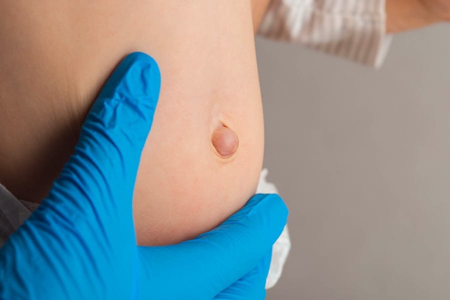 quel chirurgien opere hernie ombilicale operation docteur yann assaf chirurgie parietale paris